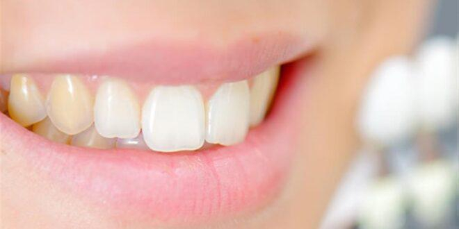 ابتسامتك صفراء؟.. 6 وصفات منزلية لاستعادة بياض الأسنان
