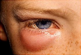 الحساسية أو انسداد القنوات الدمعية - التورم تحت العين: الأسباب والعلاج - الانتفاخ تحت العينين - السبب الكامن وراء التورم أسفل العينين