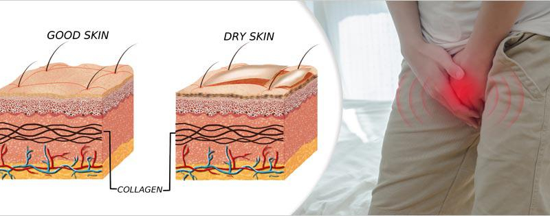 أسباب جفاف الجلد حول منطقة القضيب - مشكلة الجلد الجاف على القضيب - مشكلة جفاف الأعضاء التناسلية عند الذكور - جفاف جلد القضيب