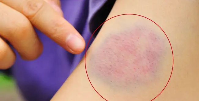 ليست خرافة…تعرف على كدمات الحزن