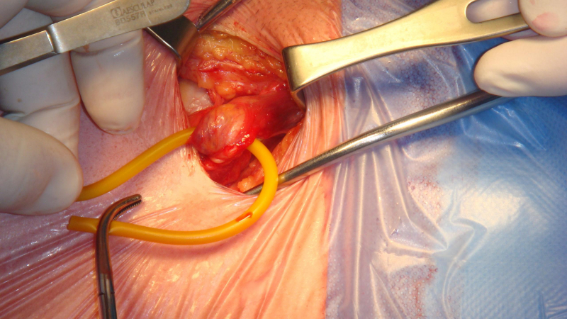 ما أشيع أنواع الفتوق وكيف تعالج - خروج الأنسجة الداخلية من منطقة ضعيفة في عضلات جدار البطن - كيف تحدث معظم حالات الفتوق في البطن