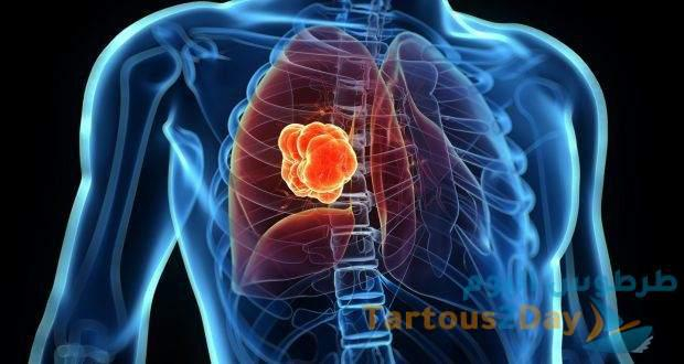 علامات و اعراض سرطان الرئة .. لن تتوقعها