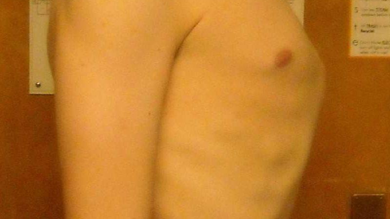 الصدر الجؤجؤي أو صدر الحمامة: الأسباب والأعراض والعلاج