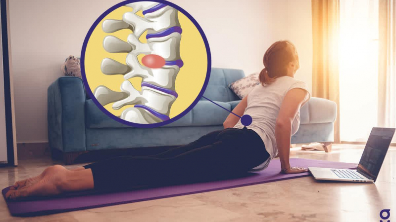 تمرينات لعلاج الانزلاق الغضروفي
