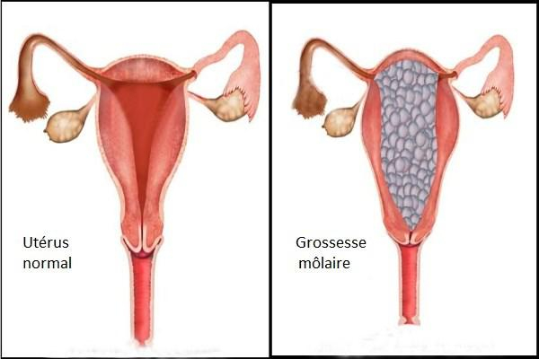 كيف يحصل الحمل العنقودي؟