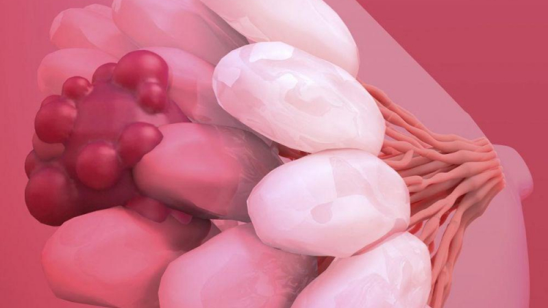 رسم توضيحي لسرطان الثدي (باللون الأحمر) في الغدد الثديية (باللون الأبيض)