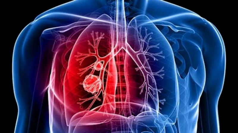 من فوائد القرنفل أنه يحارب أمراض السرطان من بينها سرطان الرئة