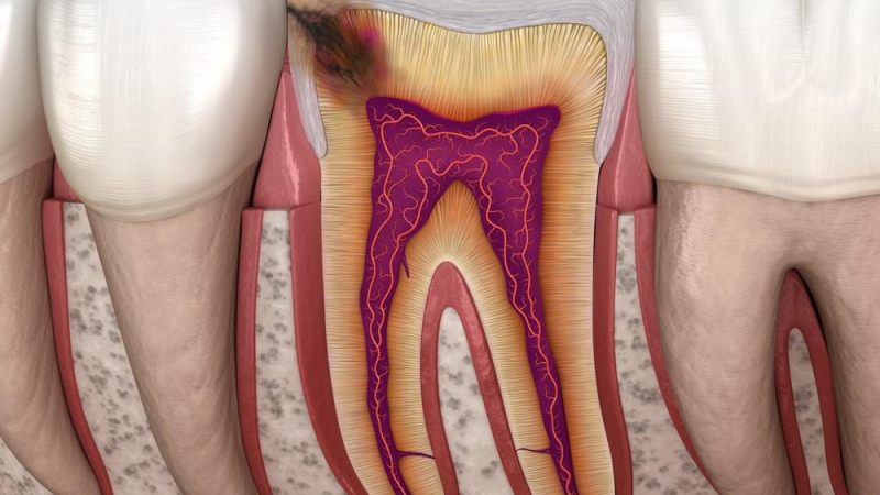 وأحياناً أمراض الأسنان كالتسوس والخراجات تسبب مرض التهاب الجيوب الأنفية