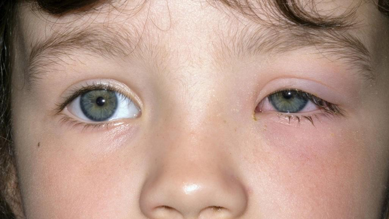 أعراض التهاب الجيوب الأنفية عند الصغار التعب والحمّى وتورم عين واحدة