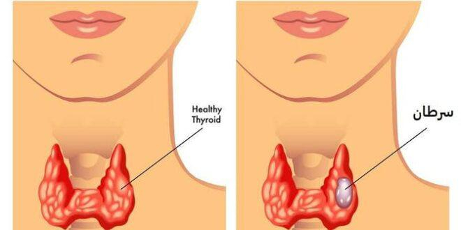 سرطان الغدة الدرقية