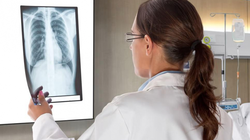 تصوير الصدر بالأشعة السينية