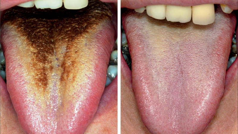 اللسان الأسود المشعر: الأسباب والأعراض والتشخيص والعلاج