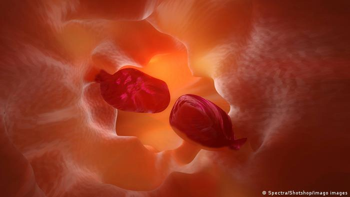 صورة لبوليبات داخل القولون.