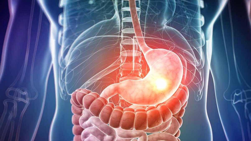 ارتجاع المريء هو اضطراب في الجهاز الهضمي