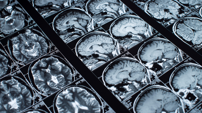 في الغالب تكون أسباب متلازمة اليد الغريبة ناتجة من اضطرابات في الدماغ