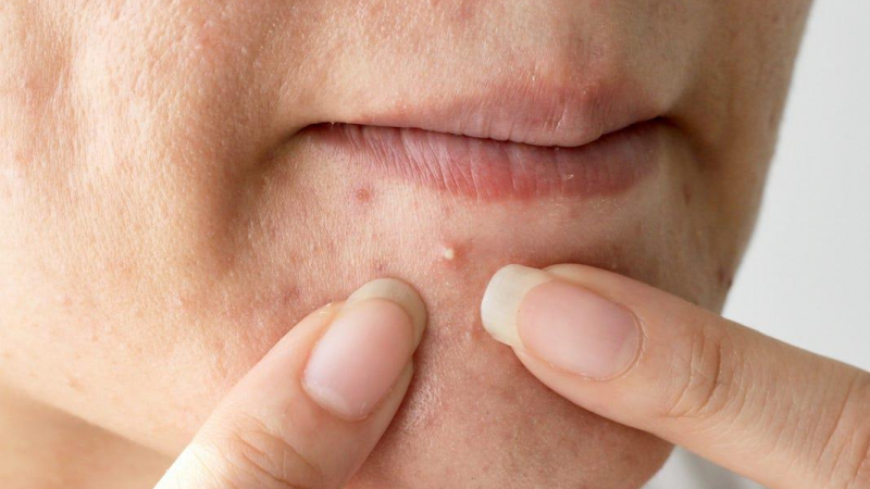 علاج حب الشباب