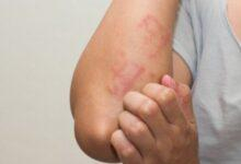 الريتان.. كيف نتجاوز الآثار السلبية لأفضل دواء لحب الشباب؟