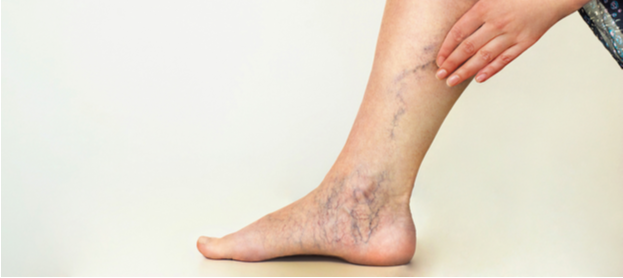 دوالي الساقين Varicose veins: الأعراض والأسباب والعلاج