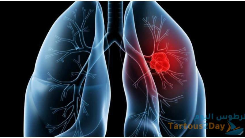 مرض الانسداد الرئوي