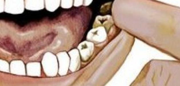 علاج الم الضرس المسوس بعلاجات منزلية بسيطة