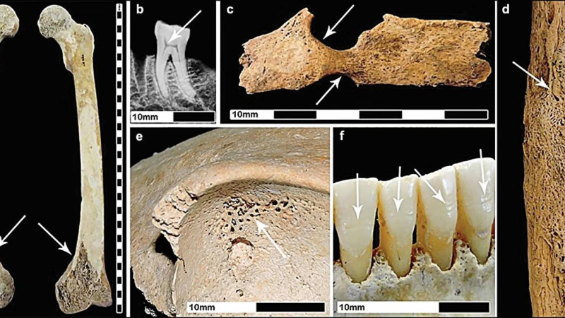 مؤشرات الإجهاد على بعض الهياكل العظمية لنساء بالغات من العصر الروماني (ريبيكا بيت/مجلة "أنتيكويتي" (2025))