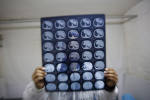 أعراض السرطان الصامتة: علامات خفية قد تكون قاتلة