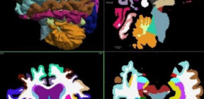 اختراق طبي: الذكاء الاصطناعي يكشف ألزهايمر بدقة غير مسبوقة